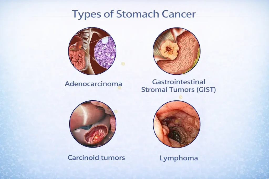 types of Stomach Cancer